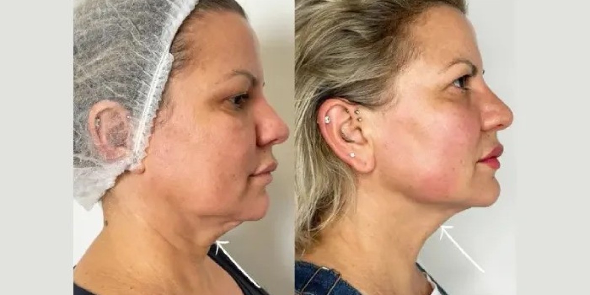 Why I’ll Always Choose the Best Aesthetic Clinic in Dubai for Endolift