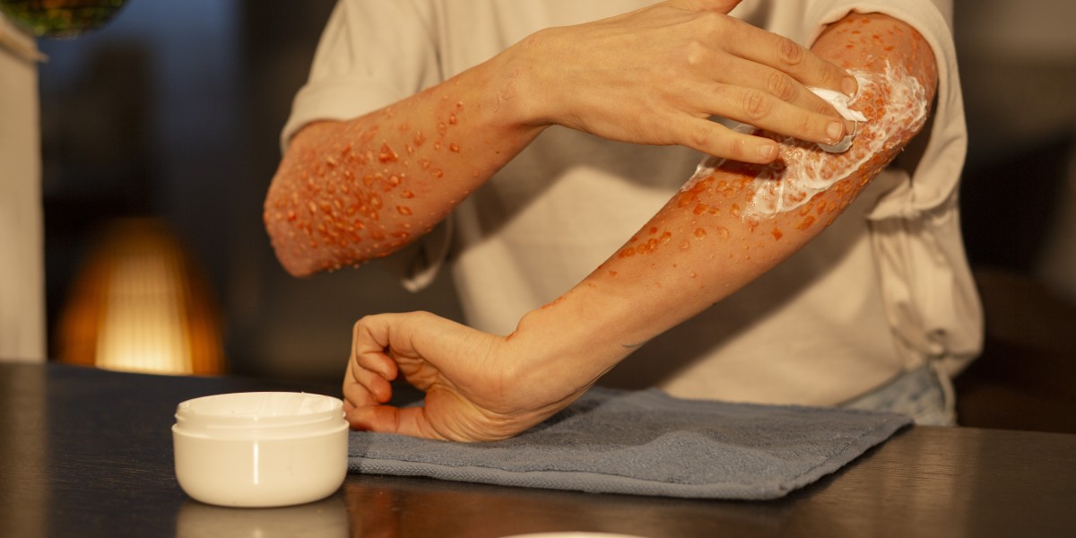 Everyday Triggers That Make Eczema Worse