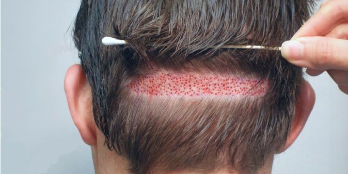 How to Choose the Right Surgeon for Hair Transplant in Lahore